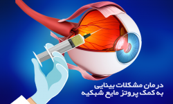 درمان مشکلات بینایی به کمک پروتز مایع شبکیه