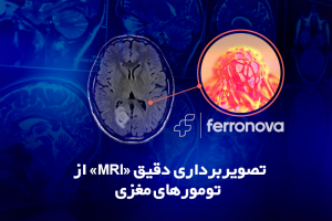 تصویربرداری دقیق «MRI» از تومورهای مغزی