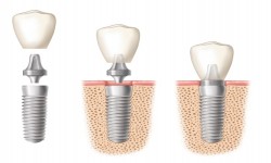 چرا بازار ایمپلنت‌های دندانی مبتنی بر فناوری‌ نانو رو به افزایش است؟